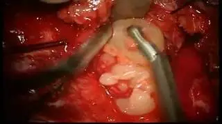 Orbital Neurofibroma