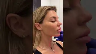 Would you try non-surgical facial contouring? #glowup #simonourian #beauty #filler