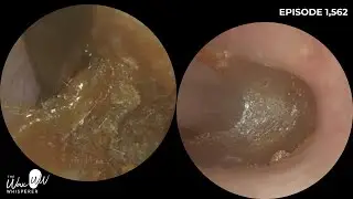 1,562 - Mrs Cotton Bud! Ear Wax Removal in a Prolific Cotton Bud User!