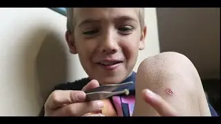 SHAE removes his OWN WART!