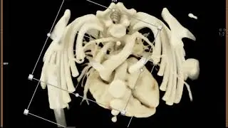 Anomalous Rt Subclavian Artery with Cinematic Rendering