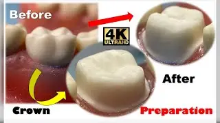 The Ultimate Crown Prep Tutorial: Lower First Molar Made Easy