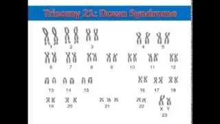 Nondisjunction