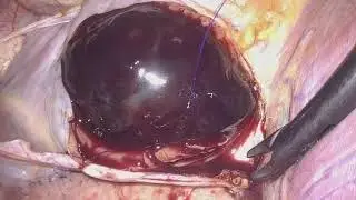 Totally Endoscopic Port-Access Artial Myxoma Resection Without Robotic Assistance