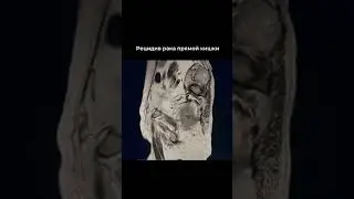 Рецидив рака прямой кишки на снимке КТ