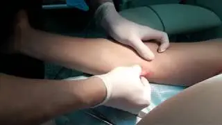 Операция по удалению жировика (липомы)