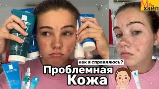 МОЯ ПРОБЛЕМНАЯ КОЖА || снова акне😭 как я справляюсь?