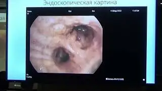 Бронхо 30 08 Цвиренко АС Трахеобронхиальный Амилоидоз Клинический случай