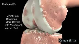 Knee pain || Reasons and treatment of knee pain | Osteoarthritis
