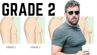 Gynecomastia Grade 2 Treatment: Achieving Optimal Results