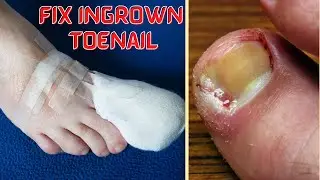 How to Fix an Ingrown at Home | How to Recut Nail Groove