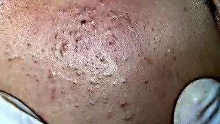 Tokyo Acne Treatment Blackhead Extractions Popping #51