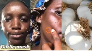 I USED GARLIC ON MY FACE FOR 2 DAYS  AND THIS IS WHAT IT DID TO MY SKIN |DANGEROUS SIDE EFFECTS