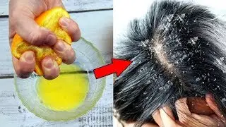 Как избавиться от перхоти. Сильный рецепт против перхоти 😍реально работает!