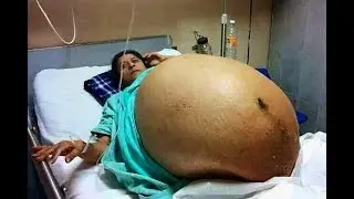 Eine frau hatte mal 11 Linge auf die Welt gebracht wie viele haben überlebt?