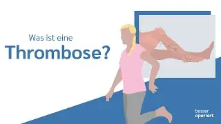 Was ist eine Thrombose? 🤓 | besser operiert
