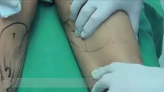 Correction of concave deformities with HYAcorp MLF1 filler