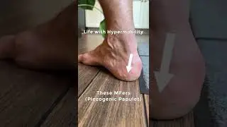 Life with hypermobility and Ehlers Danlos related symptoms 