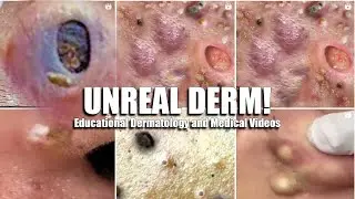 Pimple Popping, White Eyes, Weight Loss & Comedone Extractor Tools