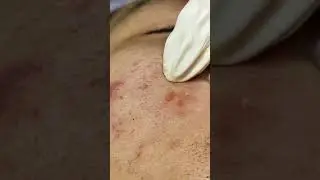 Best Satifying videos for Relaxation with Rat Tana Acne Spa =Short