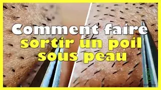 Comment faire sortir un poil sous peau
