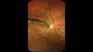 CHRONIC INFERIOR RETINAL DETACHMENT, MACULA OFF, HIGH WATER MARKS