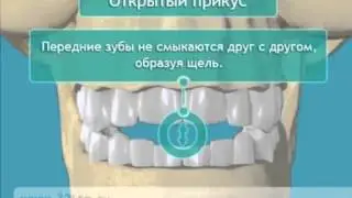 Dental Occlusion. Malocclusion