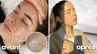 L'ACNÉ : comment je me suis débarrassée de mon plus gros complexe (spoiler : Roaccutane/Curacné)