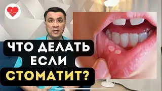 Как лечить кандидозный стоматит?