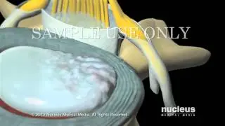 Epidural steroid injection