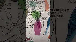 Front thigh symptoms, a hip flexor trigger point?
