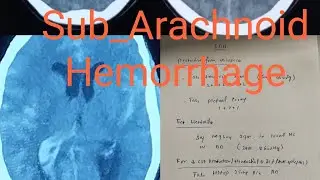 Sub_Arachnoid hemorrhage (SAH) , finding on ct brain and managment