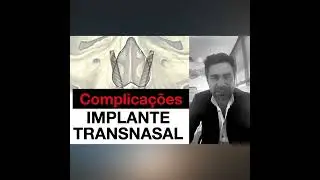 Implante Transnasal