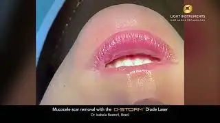 Mucocele scar removal with the D-Storm™ Diode Laser