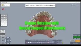 Archform Canine Rotation with Buccal-Lingual Attachments