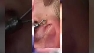 Blackhead Removal