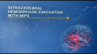 Intracerebral Hemorrhage Evacuation with MIPS