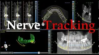 Nerve detection - Digital Nerve Drawing