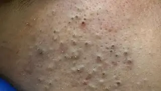 Advanced Cleansing Techniques For Severe Acne — Blackhead Removal