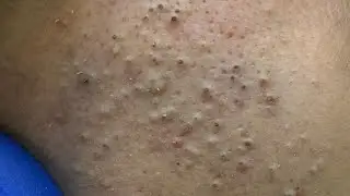 Deep Cleansing Facial Routine for Acne & Blackheads - Satisfying ASMR
