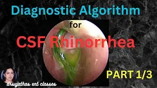 234.CSF Rhinorrhea Part 1/3 / Diagnostic Algorithm for Cerebrospinal Fluid Leak  #surgeryeducation