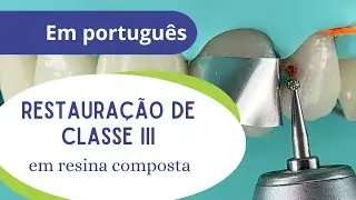 Restauração de Classe III em Resina Composta