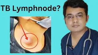 TB Lymphnode: Symptoms, Diagnosis & Treatment |Tuberculous lymphadeniyis