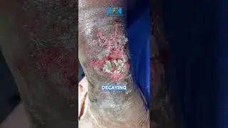 Part 1 Managing Maggot Infested Wounds: Treatment and Care
