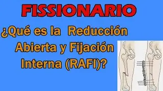 REDUCCIÓN ABIERTA Y FIJACIÓN INTERNA (RAFI) - FISSIONARIO #2