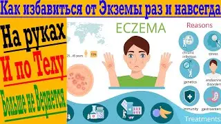 Как очистить кожу от экземы и косметических проблем! Простой способ для здоровой кожи!