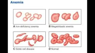 Chapter 13 Disorders of Red Blood Cells BIO216