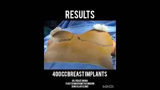 BREAST IMPLANTS SURGERY INSTANT RESULTS 👌👏👌🤩. ALWAYS CHOSE A QUALIFIED PLASTIC AND COSMETIC SURGEON