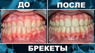 Braces before and after. Bite correction in 14 months.
