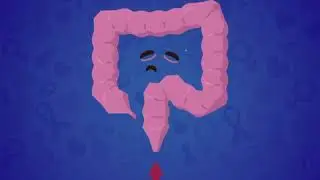 Bowel Cancer Symptoms: Blood in Stool (English)